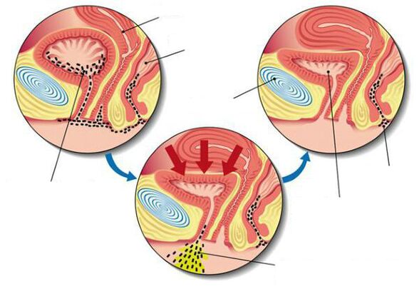bakterije v mehurju s cistitisom