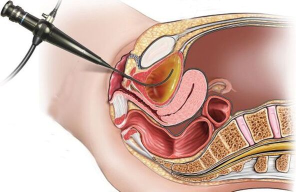 cistoskopija za cistitis
